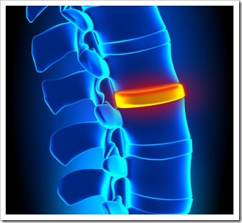 Herniated Disc and Back Pain Tigard OR