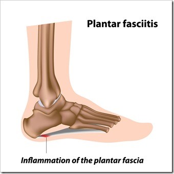 Foot Pain Tigard OR Plantar Fasciitis